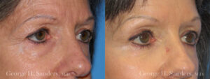 Patient 3b Eyelid Surgery Before and After