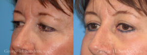 Patient 4b Eyelid Surgery Before and After