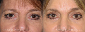 Patient 6a Eyelid Surgery Before and After