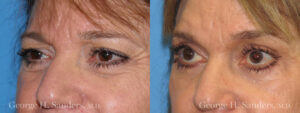 Patient 6b Eyelid Surgery Before and After