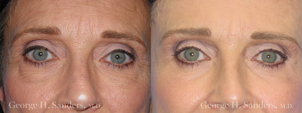 Patient 7a Eyelid Surgery Before and After