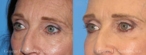 Patient 7b Eyelid Surgery Before and After