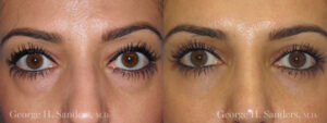 Patient 9a Eyelid Surgery Before and After