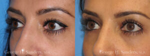 Patient 9b Eyelid Surgery Before and After