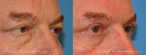 Patient 1b Male Eyelid surgery