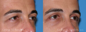 Patient 2b Male Eyelid surgery
