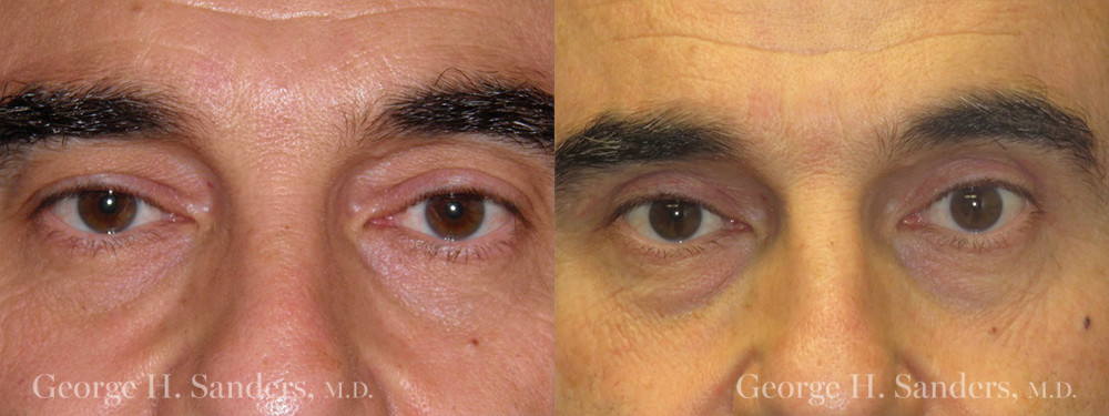Patient 3a Male Eyelid surgery