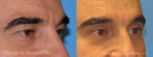 Patient 3b Male Eyelid surgery