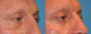 Patient 4b Male Eyelid surgery