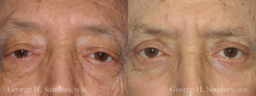 Patient 5a Male Eyelid surgery