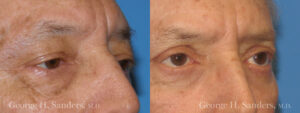 Patient 5b Male Eyelid surgery