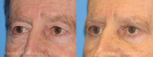 Patient 6b Male Eyelid surgery