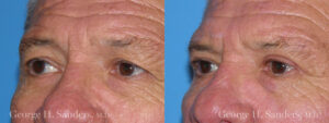 Patient 7b Male Eyelid surgery