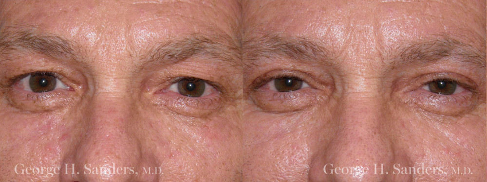 Patient 8a Male Eyelid surgery