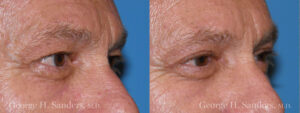 Patient 8b Male Eyelid surgery