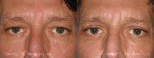 Patient 9a Male Eyelid surgery