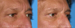 Patient 9b Male Eyelid surgery