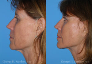 Patient 1c Face Lift Before and After