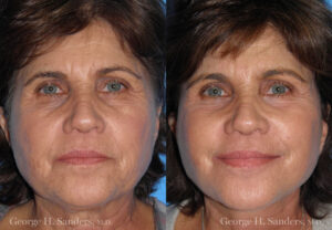 Patient 10a Face Lift Before and After