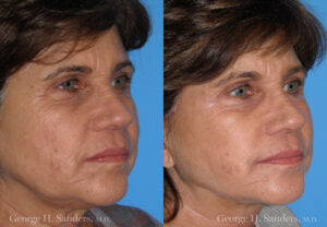 Patient 10b Face Lift Before and After