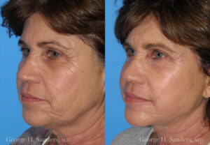 Patient 10c Face Lift Before and After