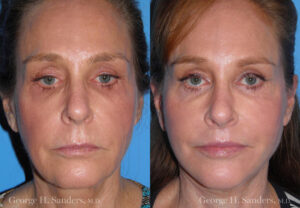 Patient 12a Face Lift Before and After