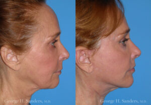 Patient 12b Face Lift Before and After