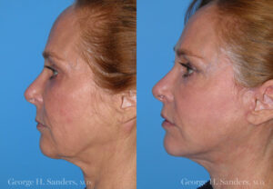 Patient 12c Face Lift Before and After