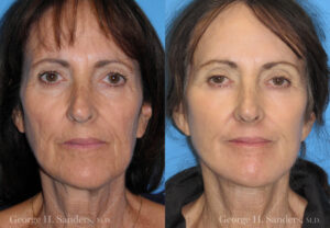 Patient 14a Face Lift Before and After