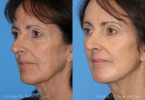 Patient 14b Face Lift Before and After
