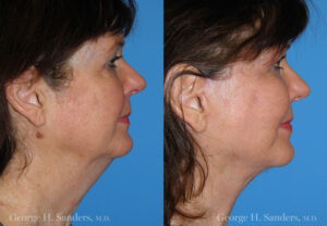 Patient 2b Face Lift Before and After