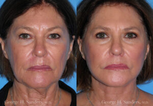 Patient 5a Face Lift Before and After