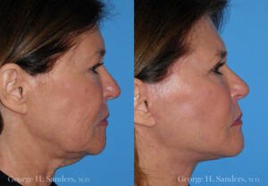 Patient 5b Face Lift Before and After