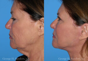 Patient 5c Face Lift Before and After
