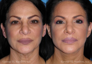 Patient 7a Face Lift Before and After