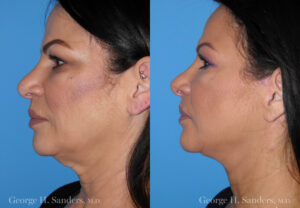 Patient 7b Face Lift Before and After