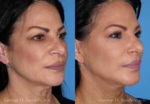 Patient 7c Face Lift Before and After