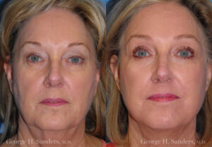 Patient 8a Face Lift Before and After