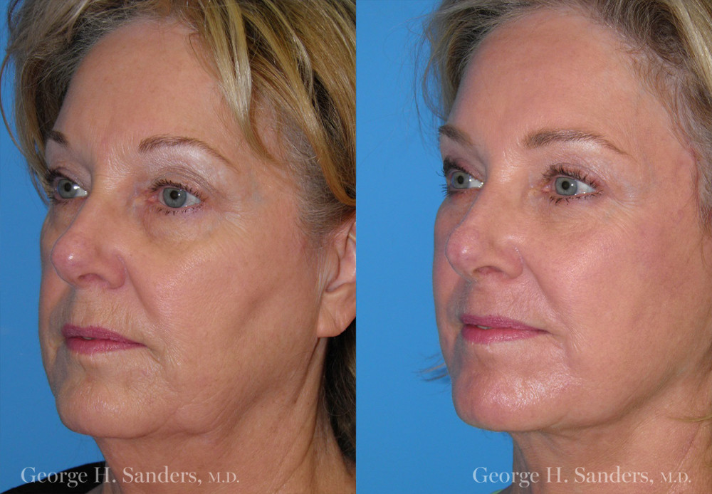 oblique view of before and after photo of a woman who received a facelift