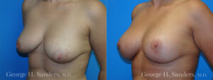Patient 1c Breast Lift Before and After