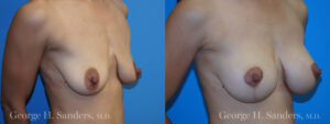 Patient 2c Breast Lift Before and After