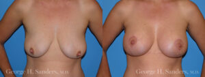 Patient 3a Breast Lift Before and After