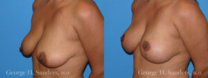 Patient 4c Breast Lift Before and After