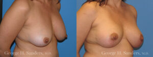 Patient 5b Breast Lift Before and After
