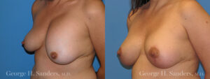 Patient 5c Breast Lift Before and After