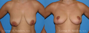 Patient 6a Breast Lift Before and After