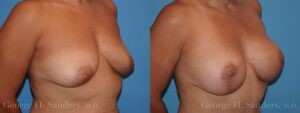 dr-sanders-los-angeles-breast-augmentation-Patient-28-2