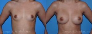 dr-sanders-los-angeles-breast-augmentation_Patient-29-1