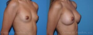 dr-sanders-los-angeles-breast-augmentation_Patient-29-2