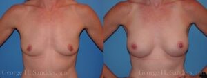 dr-sanders-los-angeles-breast-augmentation_Patient-30-1